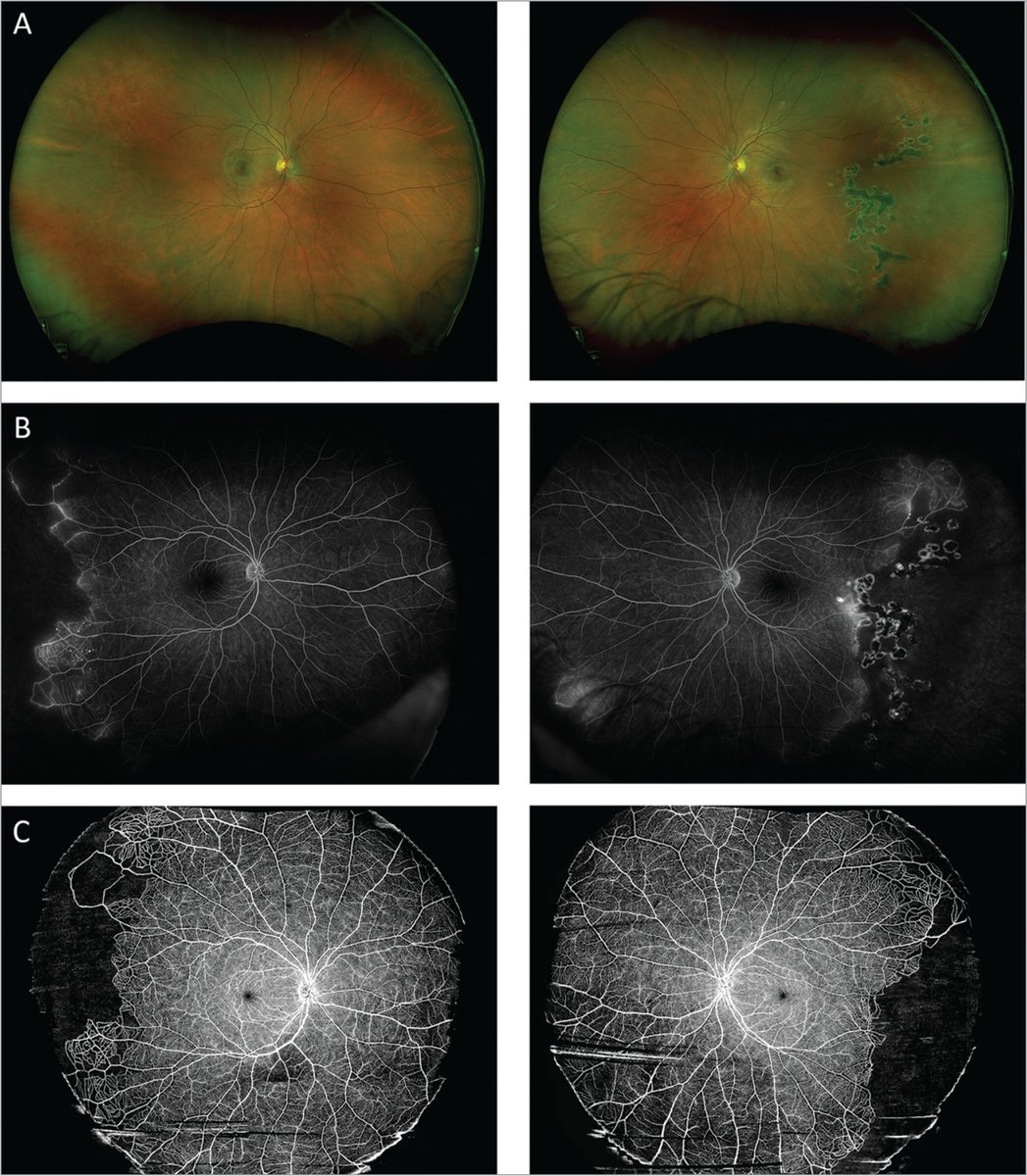 IMAGES in #Ophthalmology: 

Figure 1. Multimodal imaging in a patient with Coats plus syndrome. 

Read more: tinyurl.com/33c45nd9

#ophthalmology #retina