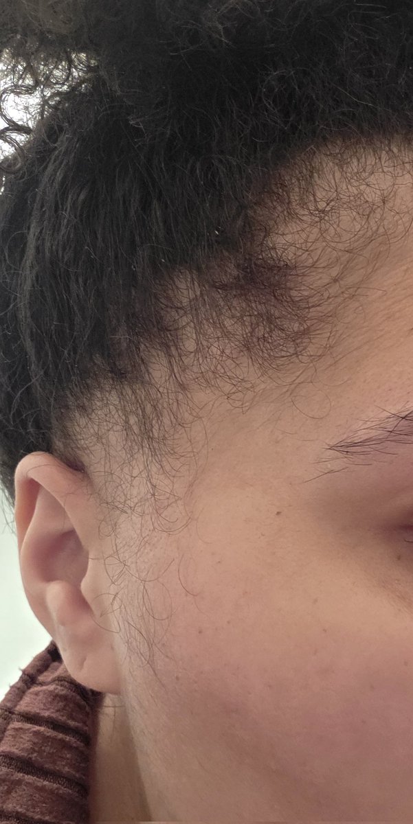 Haven't been on here in ages! 
This picture really masks the changes that are happening for me, thank God for makeup boy lol.
Loss of hair/serious thinning
Loss of eyebrows/eyelashes
Face swelling from steroids
Weight gain
But I am pleased to say I have 1 chemo left😪