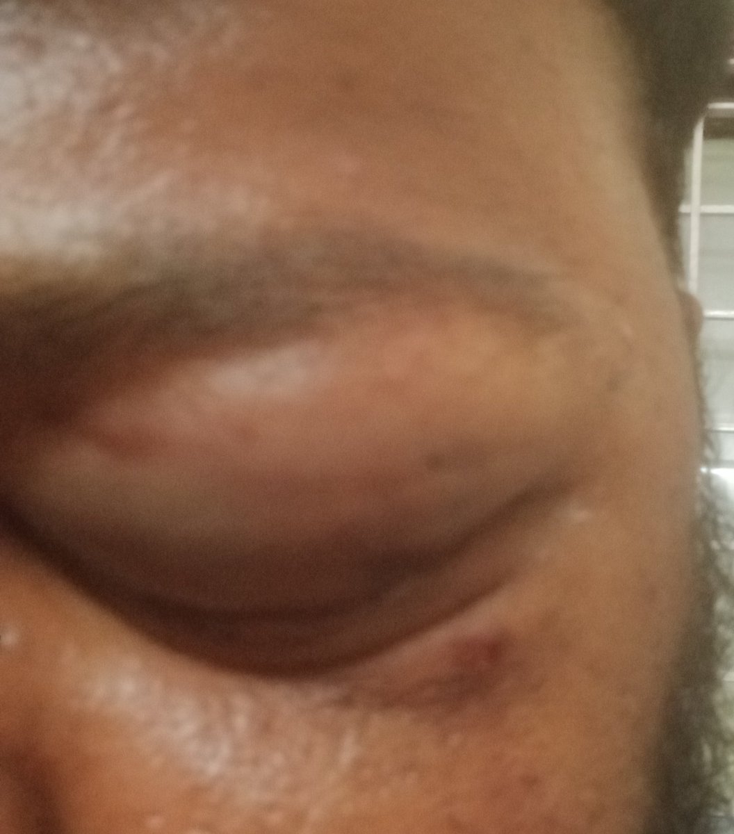 Brekshrek's tweet image. Got hit by a car while going to work.

Collar bone fractured, lost 2 teeth and 6 stitches on my leg.

Will stay inactive for sometime.