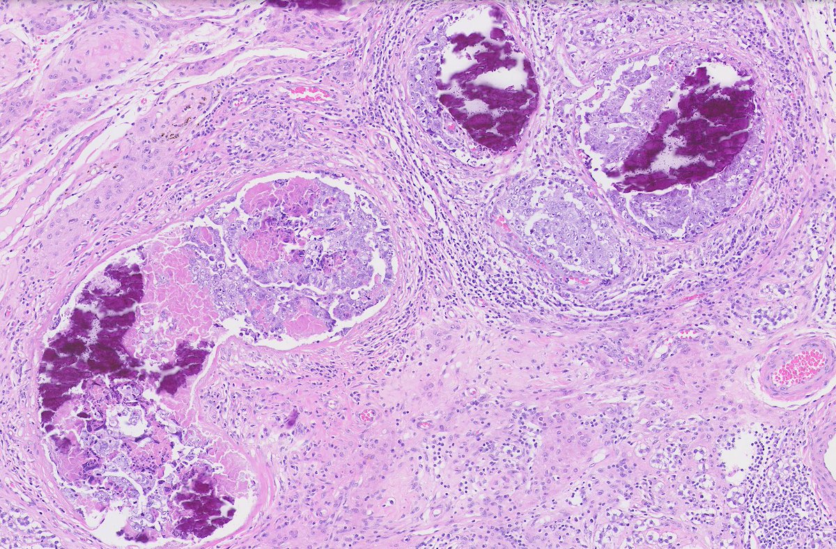 Intratubular embryonal carcinoma #pathology #pathologists #pathtwitter
