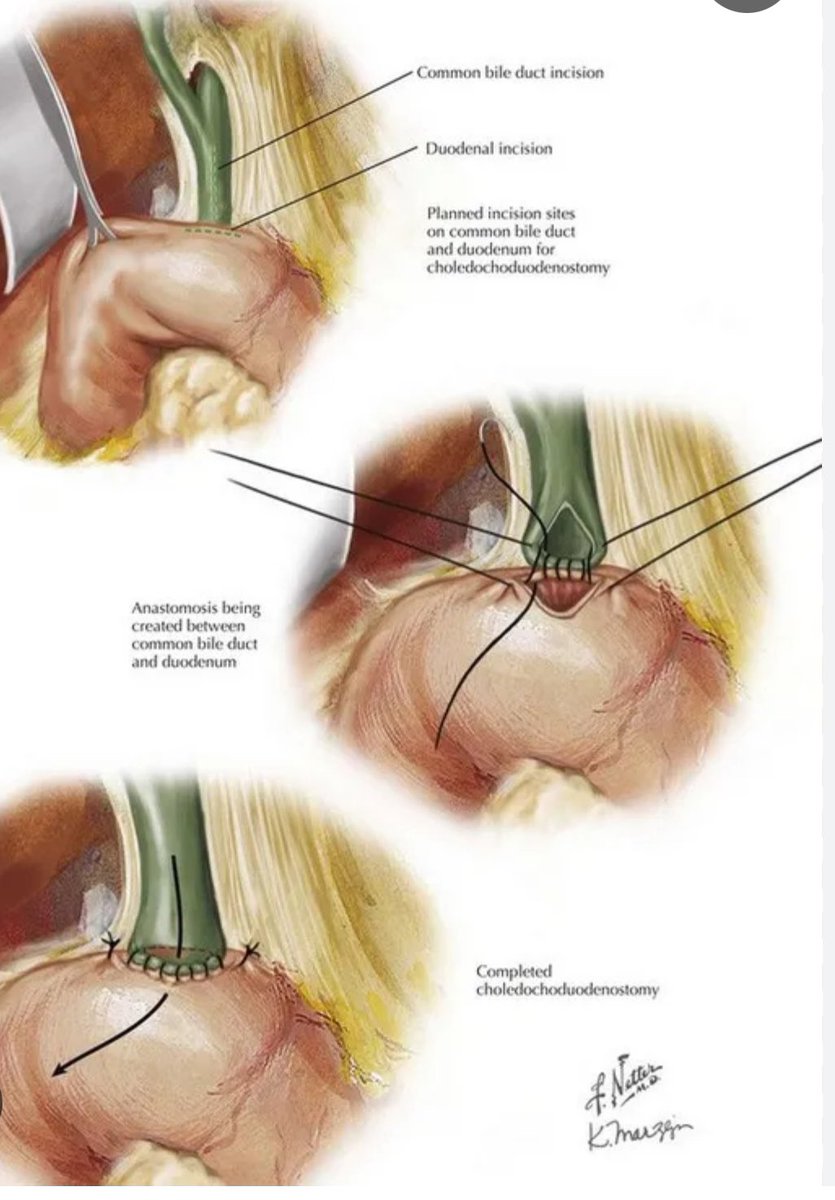 Syed A. Ahmad (@syedaahmad5) on Twitter photo Choledochoduodenostomy.
Note the direction of incisions.
<a href="/SAGES_Updates/">SAGES is in Tampa in 2026!</a> <a href="/juliomayol/">Julio Mayol</a> <a href="/TomVargheseJr/">Tom Varghese Jr. MD, MS, MBA, FACS, MAMSE ๐บ๐ธ</a> Choledochoduodenostomy.
Note the direction of incisions.
<a href="/SAGES_Updates/">SAGES is in Tampa in 2026!</a> <a href="/juliomayol/">Julio Mayol</a> <a href="/TomVargheseJr/">Tom Varghese Jr. MD, MS, MBA, FACS, MAMSE ๐บ๐ธ</a>