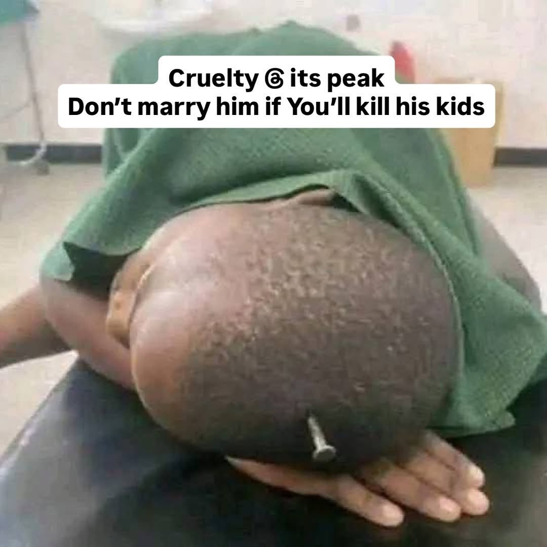 DefenceTimesNG1's tweet image. A Grade 3 boy is in the hospital awaiting surgery after his stepmother allegedly nailed his head for eating a boiled egg without permission.