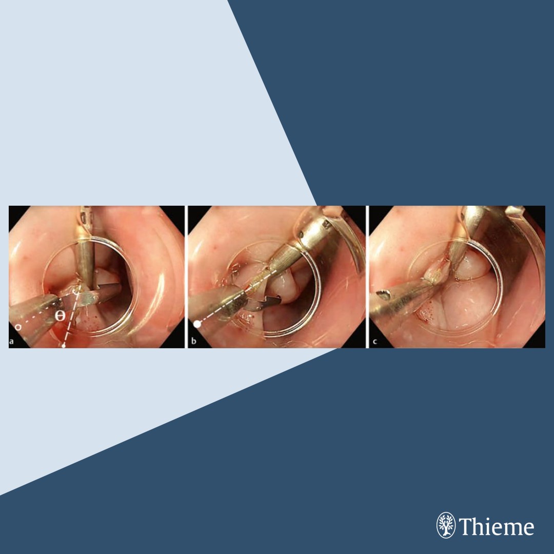 Editor’s Choice: ESGE Position Statement: Curriculum for training in peroral endoscopic myotomy (POEM) in Europe (Part II) – Best Practice Techniques
 
Find the article at: doi.org/10.1055/a-2569…
 
David J. Tate et al.
