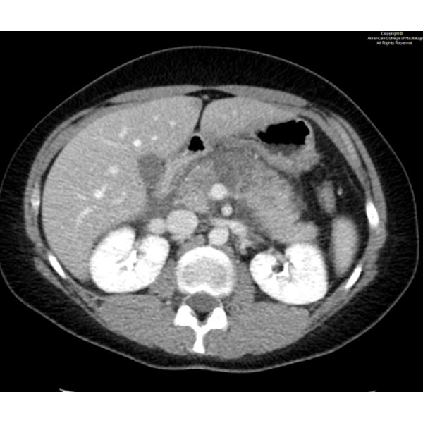 RadiologyACR's tweet image. A 22-year-old woman with a history of alcohol use disorder presents with a 6-day history of acute, severe abdominal pain, nausea, and vomiting.#ACRCaseinPoint bit.ly/3ZL0izF