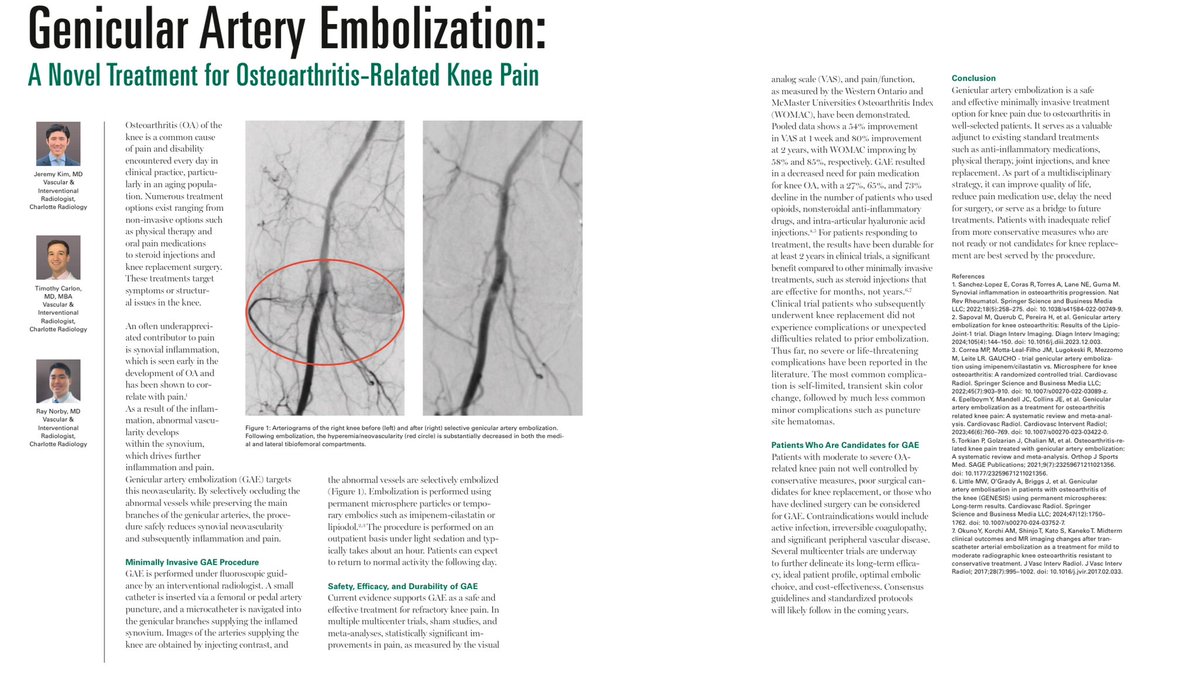 DrGluRu's tweet image. We authored an article for Medical Professionals CLT highlighting Genicular Artery Embolization (#GAE)—an innovative treatment for #kneepain caused by osteoarthritis. #irad @theobserver @wcnc @SIRspecialists