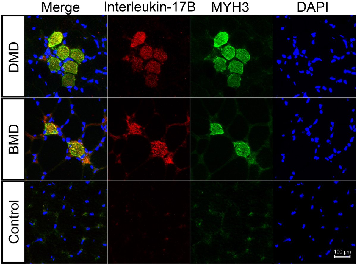 Brain1878's tweet image. By conducting a multiomics study comparing muscle biopsy samples from patients with Duchenne muscular dystrophy, Becker muscular dystrophy, and other acquired and inherited myopathies, Liu et al. identify interleukin-17B as a marker of muscle regeneration. tinyurl.com/vx9syrar
