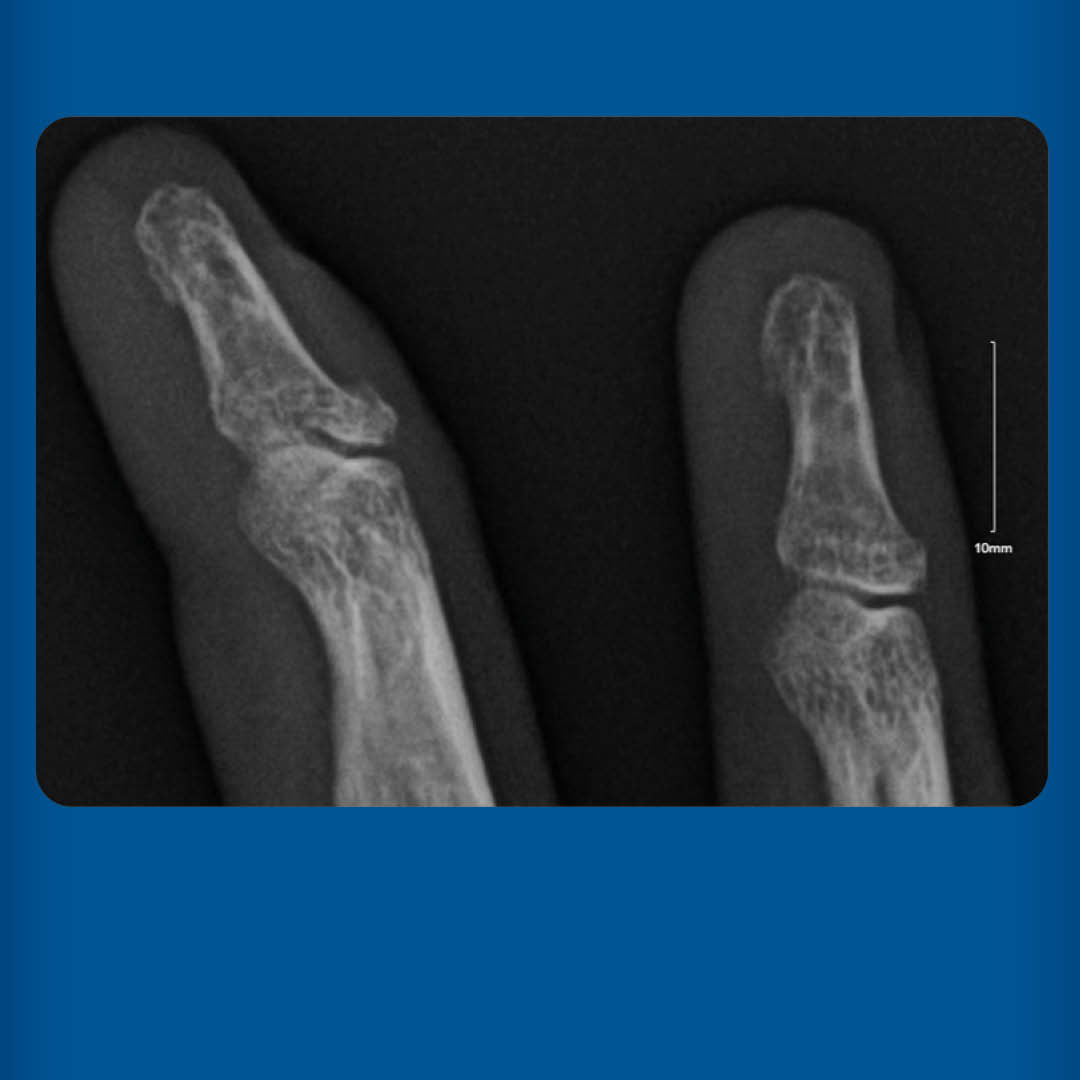 AFPJournal's tweet image. Family physicians play a pivotal role in providing timely care for common fingertip injuries and minimizing long-term disability after injury. Learn more: bit.ly/3Uhm6zA #FamilyMedicine #AFPJournal