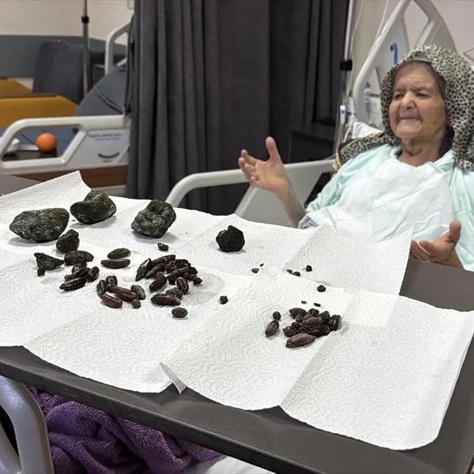 PicturesFoIder's tweet image. In Turkey, 35 olives, 28 date seeds and 5 stones were removed from the stomach and intestines of a 92-year-old woman.
