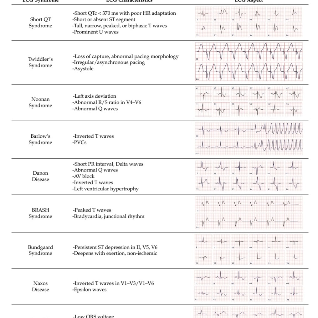 🔴Broad Electrocardiogram Syndromes Spectrum:⤵️ #2025Review #openaccess 

🔹From Common Emergencies to Particular Electrical Heart Disorders—Part II
🔹mdpi.com/2075-4418/15/1…
 #FOAMed #MedEd #medstudent #paramedic #Cardiology #CardioEd #medtwitter #meded #CardioTwitter