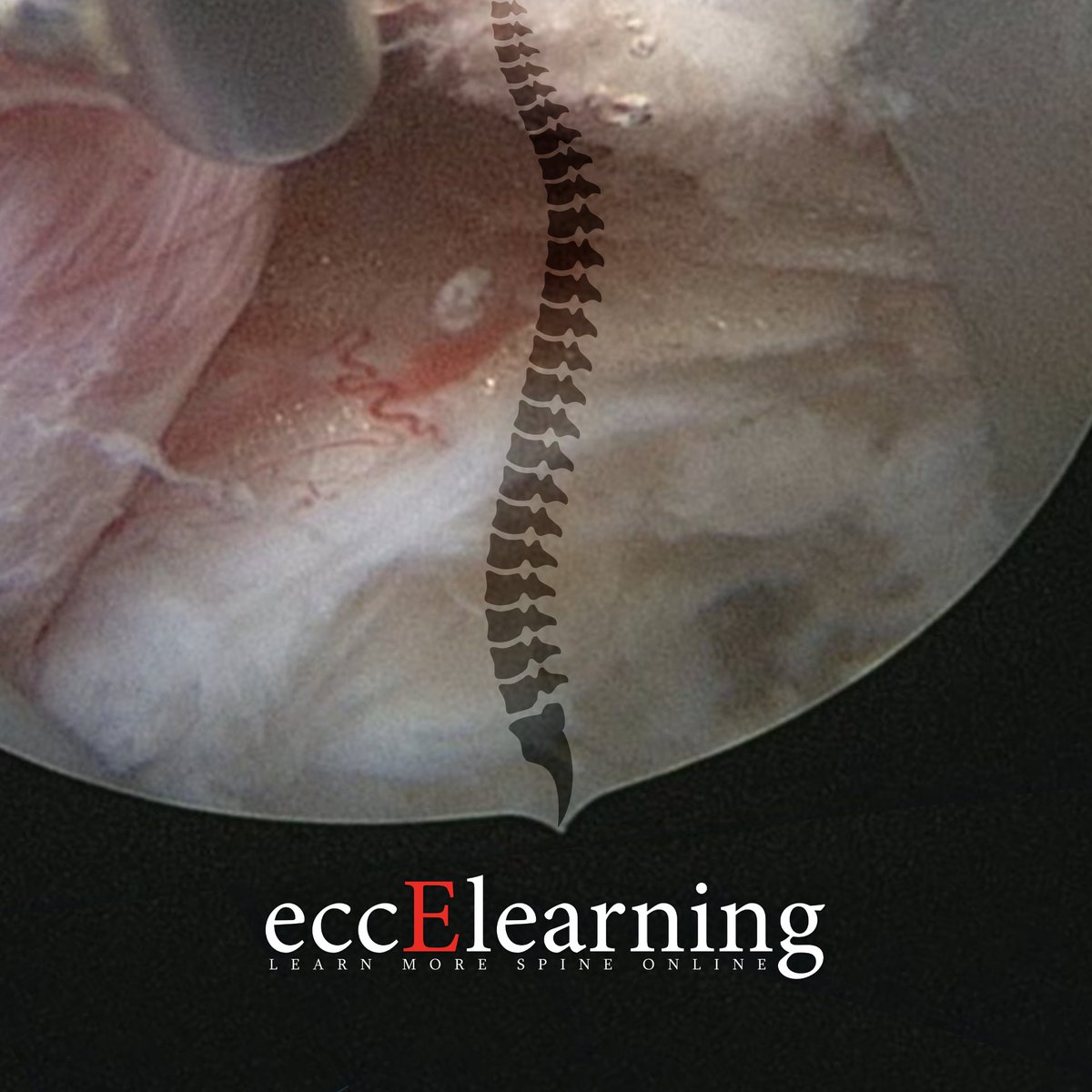 👨‍⚕️Want to learn endoscopic spine techniques?
👨‍⚕️Limited access to spine endoscopy expertise in your region?
👨‍⚕️Wonder how you could integrating endoscopy into your existing practice?
➡️Learn More: eccelearning.com/lp/endoscopic-…