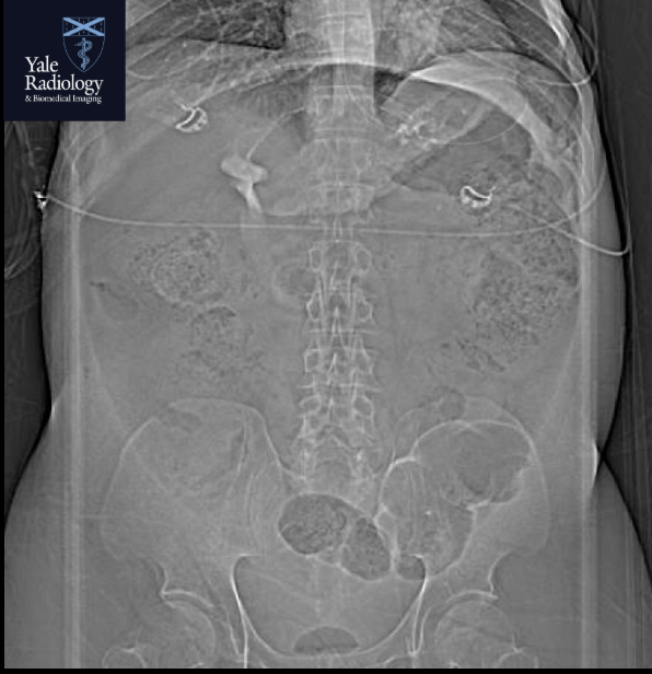 Mahan_Mathur's tweet image. #MEDSTUDENTMONDAYS: great example of the "football" sign of pneumoperitoneum/free air on X-rays! #yaleradedu #yaleradiology #MedStudentMondays #FOAMrad #FOAMed #radres @RadDiscord #MedTwitter @YaleRadRes @Yale_IR
