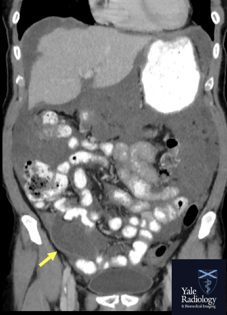 Mahan_Mathur's tweet image. TEACHING COD: high-grade appendiceal mucinous neoplasm (arrow) with pseudomyxoma peritonei! #FOAMrad #FOAMed #radres #medstudent #radiology @RadDiscord #MedTwitter @YaleRadRes @Yale_IR