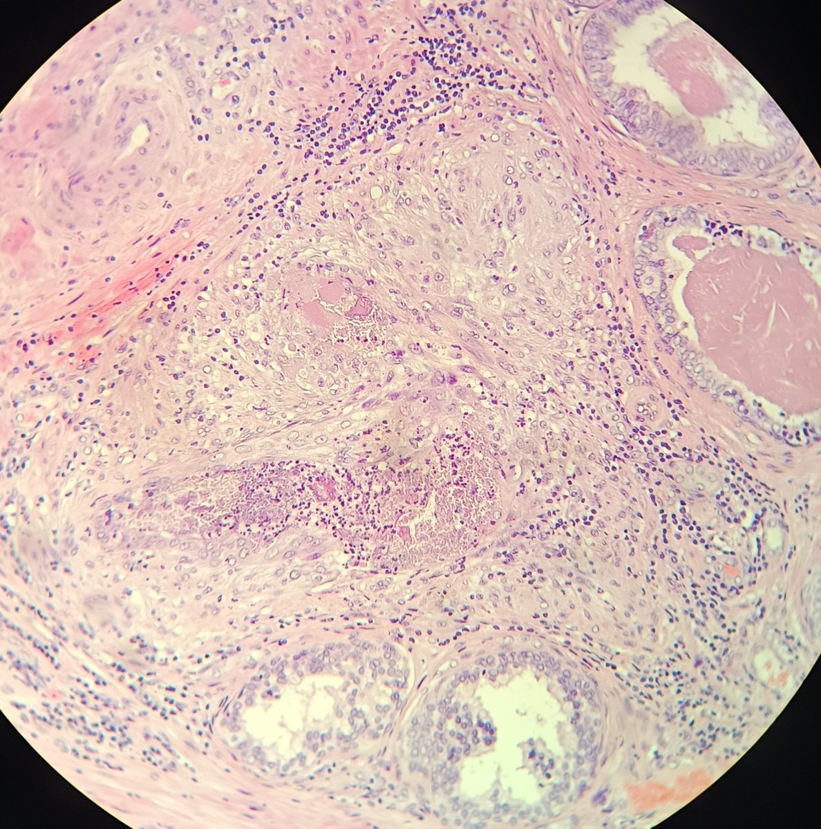 gemamoreno91's tweet image. Pieza de prostatectomía radical. pensaba que este foco era un granuloma, pero resulta que no lo es. ¿Sabéis lo que es?