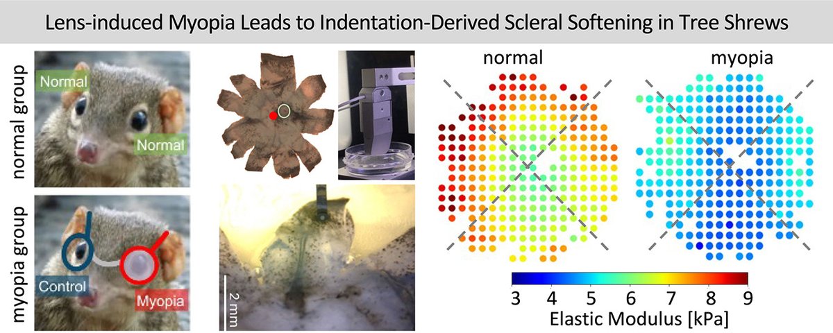 medntdj's tweet image. Professor Johannes Weickenmeier: Microindentation reveals softening of the equatorial and anterior sclera during early myopia development in tree shrew eyes sciencedirect.com/science/articl…
@weickenmeierlabm @FollowStevensm @UABophtho
via @ActaBio