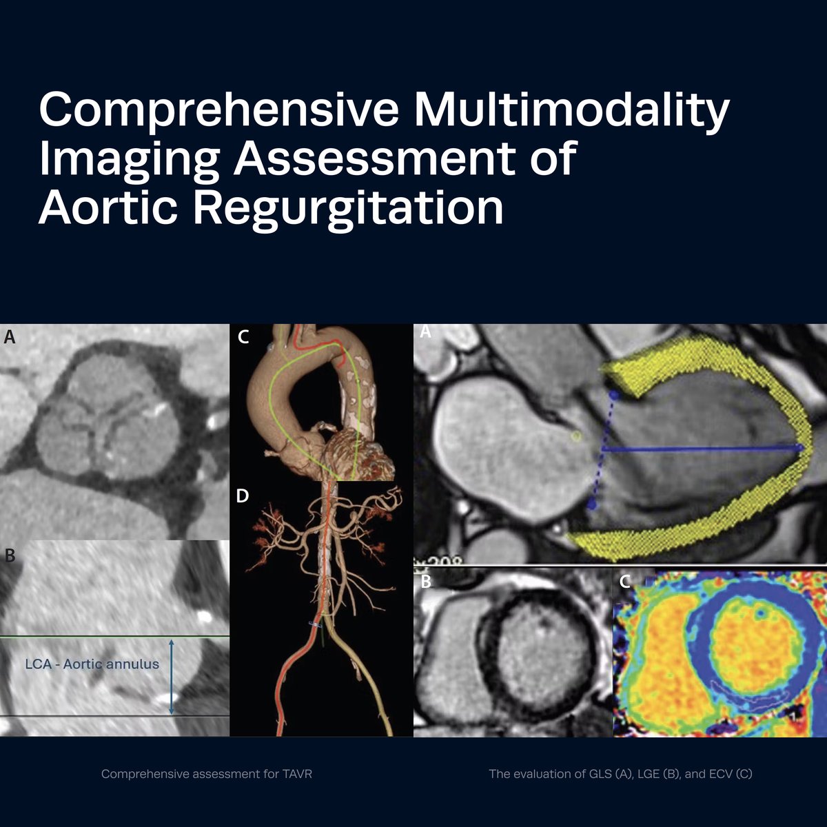 Aortic regurgitation presents unique diagnostic challenges. This recent Cardiac Interventions Today article offers an overview of multimodality imaging to accurately assess AR severity and guide intervention planning.

Key Points:

- New standards for AR quantification
- LV