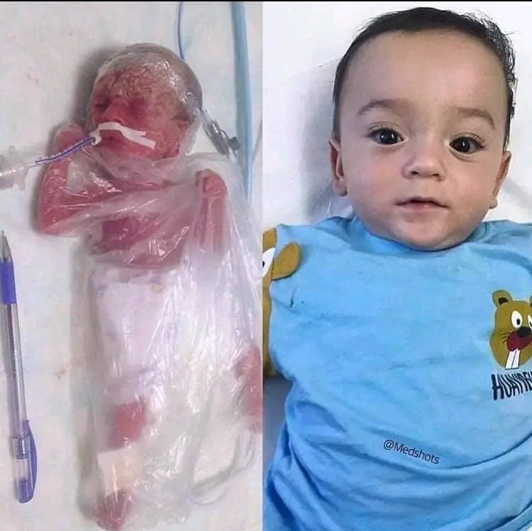 Ezekle1's tweet image. 💙 Against all odds… he chose to live.
On the left — a tiny warrior wrapped in plastic.
The size of a pen.
Skin still translucent.
A life just beginning.
An extremely premature baby. Critically underweight.
Doctors said his chances were almost zero.
“Maybe he won’t make it…”…