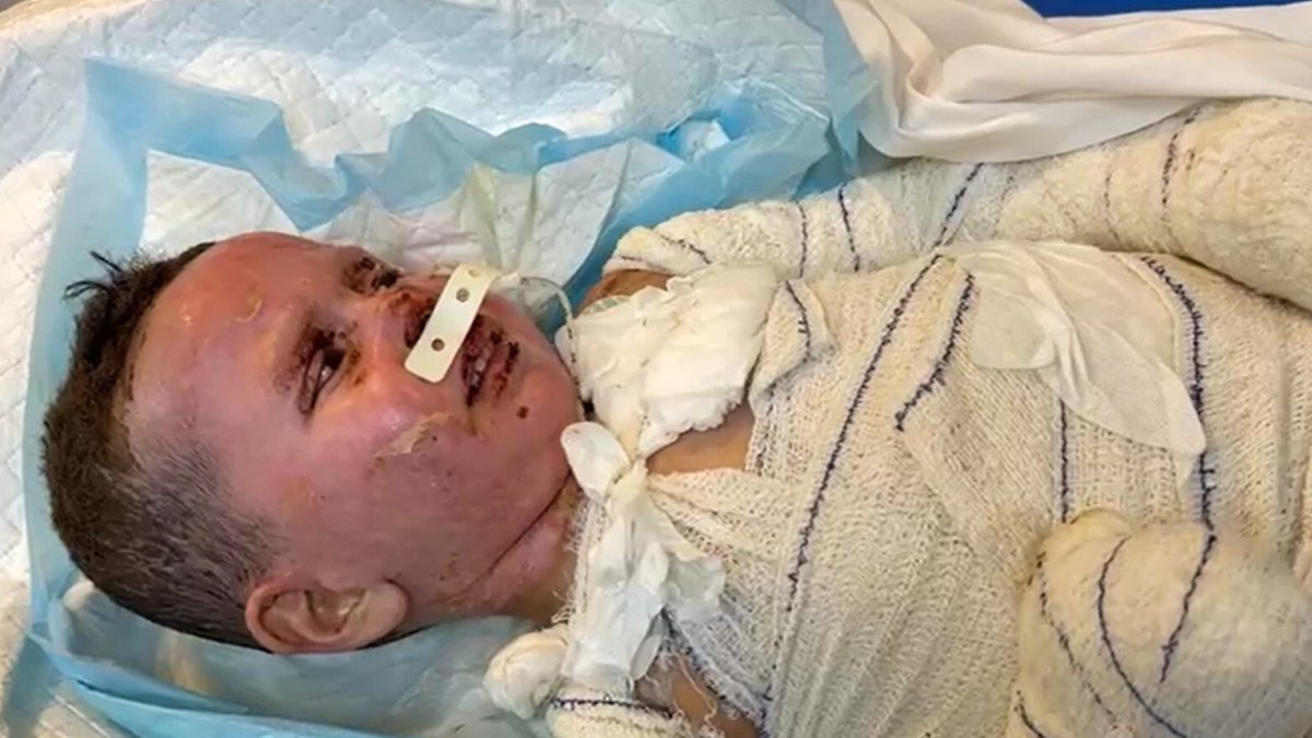 daniaakkad's tweet image. There was a hospital bed waiting in London for Haitim
His parents were killed in May when a bomb hit their home in Gaza. Their 3-yr-old survived with major burns
Doctors wanted to bring him to the UK for treatment he couldn't get in Gaza
He ended up in Italy. Why?
A 🧵