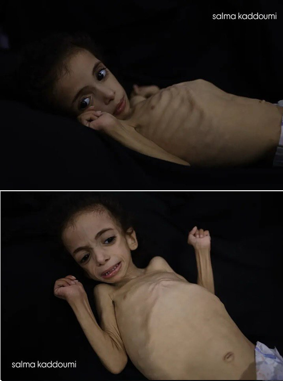 CharliesIngalls's tweet image. 🇵🇸 Razan Abu Zaher a succombé hier à #Gaza. La petite fille de 4 ans perdait du poids chaque jour depuis des semaines. En France, Caroline Yadan et Aurore Bergé veulent une loi pour interdire l'utilisation du mot génocide à #Gaza
Début juillet, sa famille avait lancé un appel à…