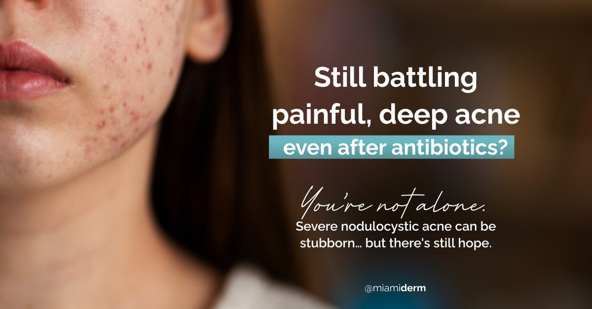 Anna H Chacon, M.D. FAAD (@drmiamiderm) on Twitter photo Stubborn #cysticacne that isn’t responding to antibiotics?
Options like isotretinoin, hormonal therapy & cortisone injections can make a difference.
📍 Coral Gables or virtual consults 24/7 across the U.S. & PR — let’s build a real plan.
app.squarespacescheduling.com/schedule.php?o…
#acnesolutions Stubborn #cysticacne that isn’t responding to antibiotics?
Options like isotretinoin, hormonal therapy & cortisone injections can make a difference.
📍 Coral Gables or virtual consults 24/7 across the U.S. & PR — let’s build a real plan.
app.squarespacescheduling.com/schedule.php?o…
#acnesolutions