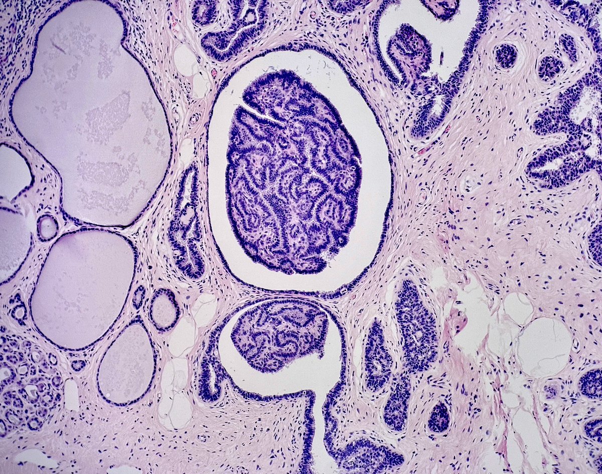 MBBS_Pathology's tweet image. Happy Monday 💙
#IntraductalPapilloma
#pathology 
#BreastPath