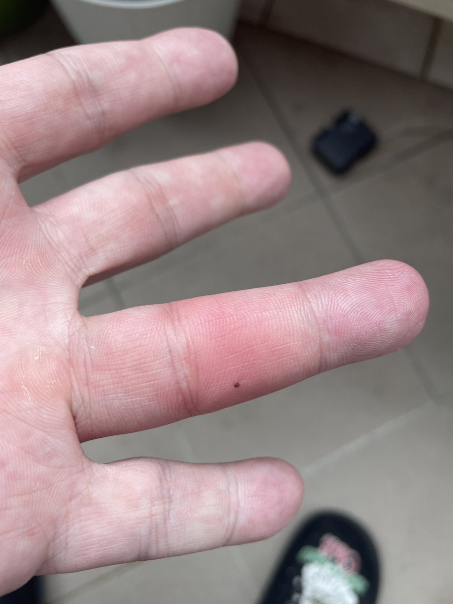 Butchi_9O5's tweet image. Anabáze s polskou včelou nekončí, dneska mi to po týdnu oteklo tak, že neohnu prst, a začalo kurevsky svědit. Upadne mi prst?