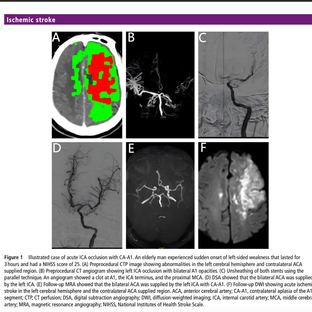 JNIS_BMJ's tweet image. Did you know CT perfusion (CTP) can quickly spot rare brain artery variants during an acute stroke? In internal carotid artery occlusions with contralateral A1 agenesis (CA-A1), CTP nails diagnosis with over 95% accuracy. Additionally, use of a double stent retriever (DSR)…