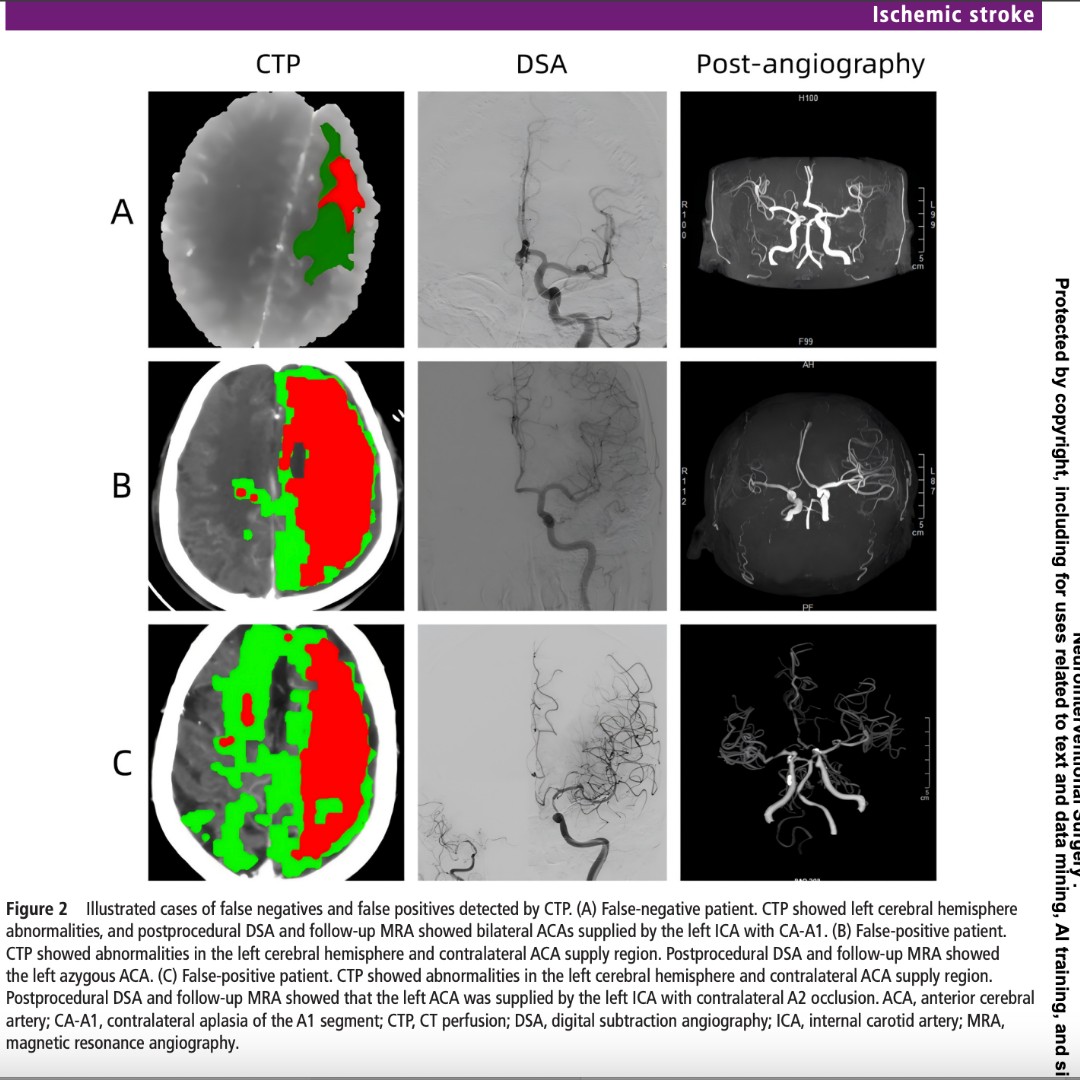 JNIS_BMJ's tweet image. Did you know CT perfusion (CTP) can quickly spot rare brain artery variants during an acute stroke? In internal carotid artery occlusions with contralateral A1 agenesis (CA-A1), CTP nails diagnosis with over 95% accuracy. Additionally, use of a double stent retriever (DSR)…
