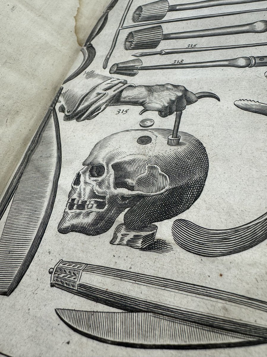 theAliceRoberts's tweet image. I’ve spent a fascinating day digging into the archives at Bart’s Hospital - learning about 17th century surgery - and discovering a new word, to me: “sphacelus”. This is all for a new series on the history of medicine - so I’ll be sharing all this and much more with you in the…