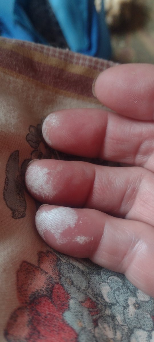 AlmostAmish1's tweet image. Be careful mark your jars of everything. Yes, I always think I will remember but I burned my fingers with full strength food grade peroxide today just trying to figure out what was in that jar. Not a big deal. I rinsed it well and my healing salve already fixed it. I'm labeling…