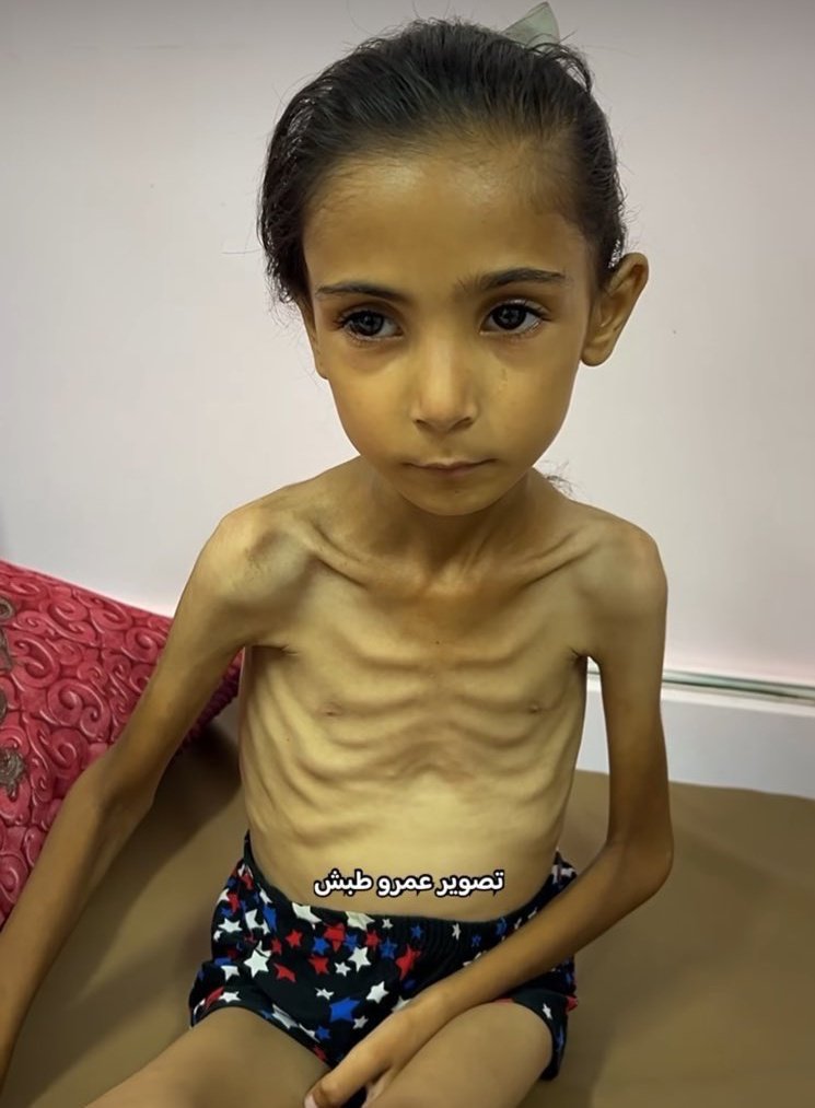 AboAsam52's tweet image. في غزة لا يموت الأطفال من القصف وحده بل يفتك بهم الجوع قبل أن تصلهم القذائف
بطونهم الخاوية تصرخ وأعينهم الغائرة تبحث عن كسرة خبز بين الركام.هناك الموت له طعم الجوع ورائحة الخبز المفقود أغلى من الأمان يجوع الأطفال حتى تغيب ملامحهم ويصارعون الموت بلا صوت ولا نجدة.
الى الله المشتكى