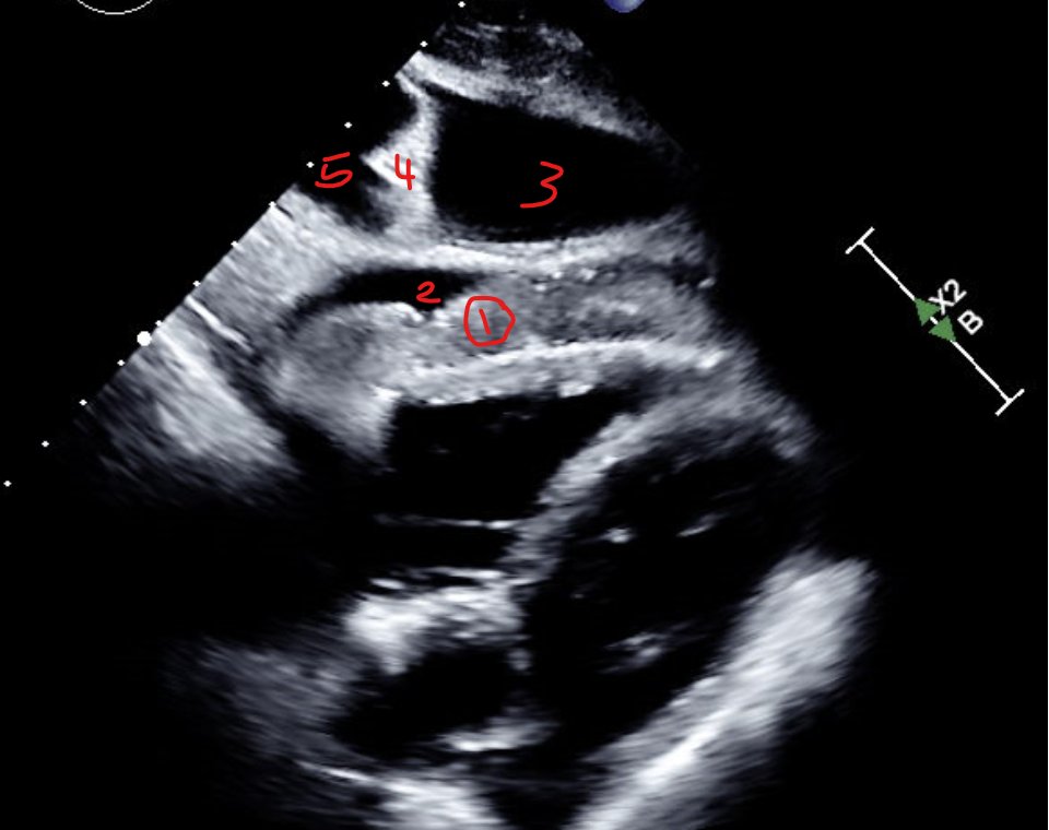 #_POCUS
In this subcostal view, can you identify these structures ?