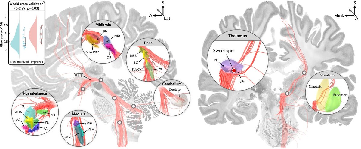 aipulserx's tweet image. Can deep brain stimulation targeting specific thalamic regions and neural pathways effectively restore consciousness in patients with severe brain injuries?@MassGenBrigham @NatureComms
"A human brain network linked to restoration of consciousness after deep brain stimulation"…