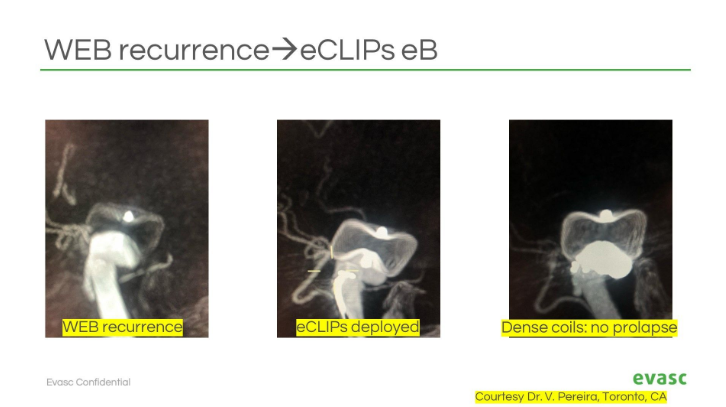 Grateful to Dr. Vitor Mendes Pereira for sharing two powerful cases at #SNIS2025:
-  Ruptured basilar recurrence post-WEB: “...only options were clip or #eCLIPs...”
- Carotid bifurcation treated with eCLIPs eBFD

🔗 bit.ly/contact-evasc