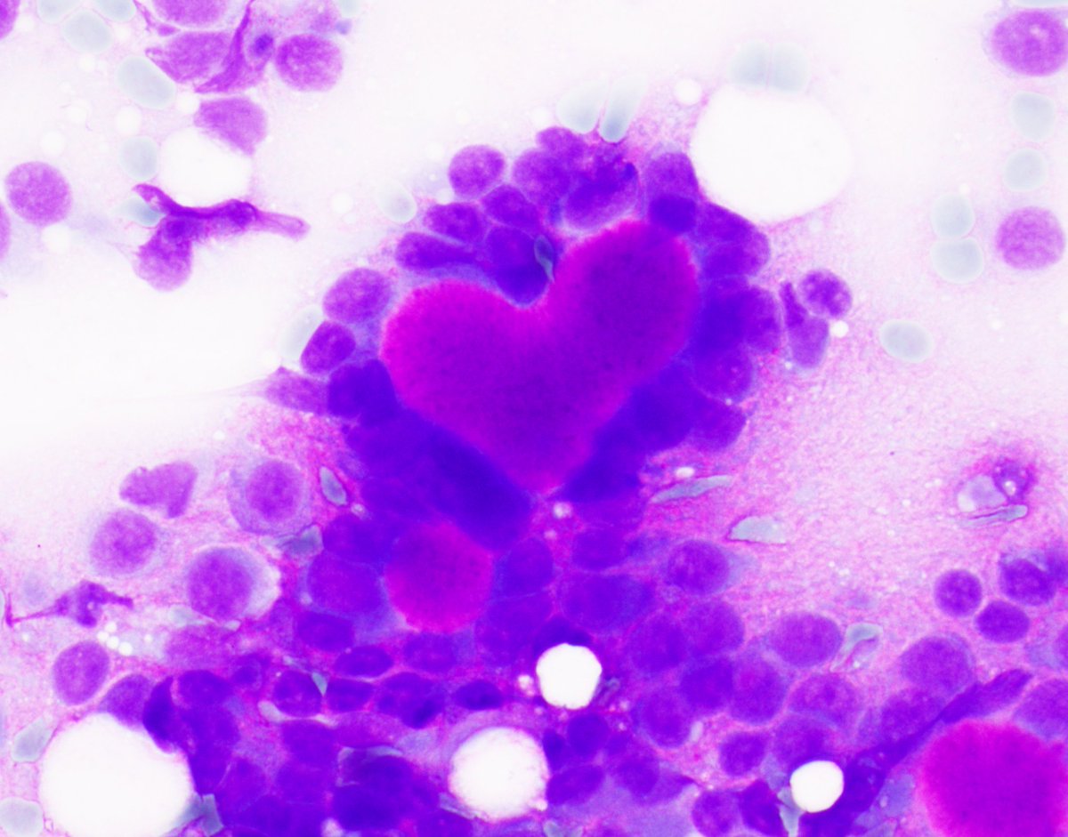 Parotid adenoid cystic carcinoma

#CytoPath #PathTwitter
