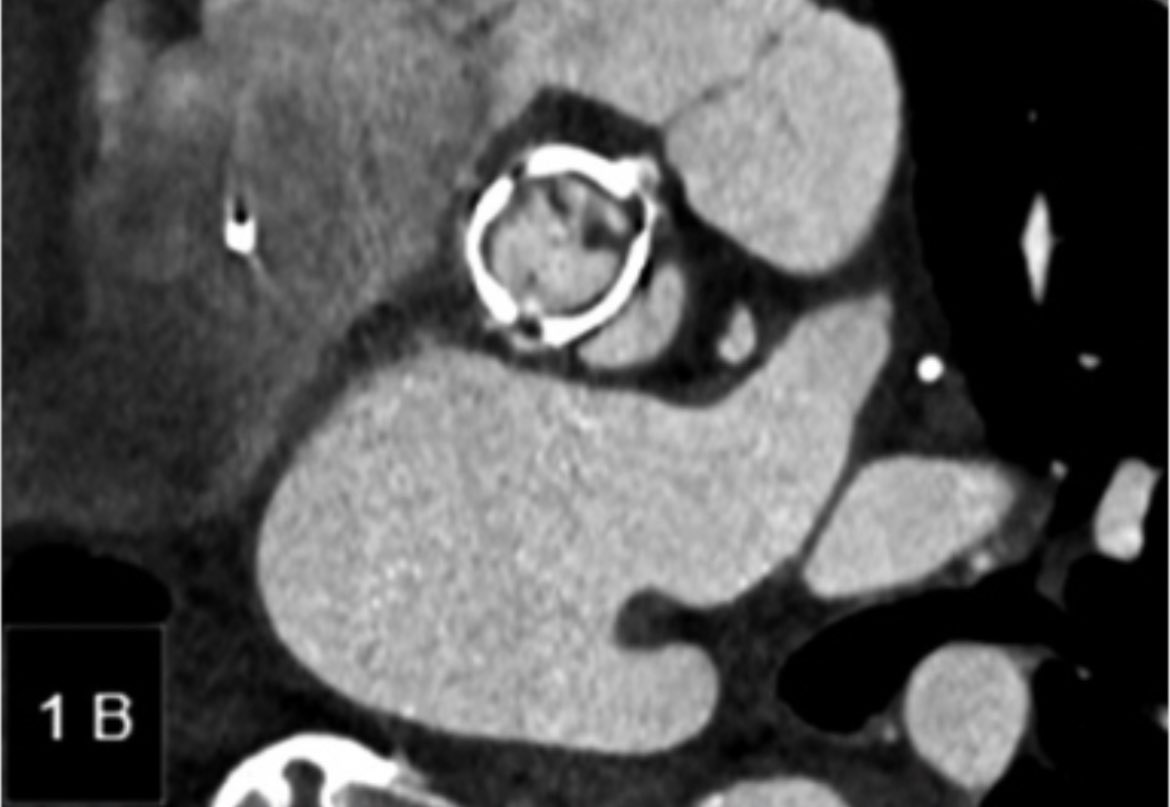 RADdschneider's tweet image. 📖👓 Utilidad Angio-TC cardíaco en la evaluación de la endocarditis infecciosa. Una revision de hallazgos en casos locales, lee el artículo completo acá ➡️ revistamedicadechile.cl/index.php/rmed… @marzagod @medufro @AlemanaTemuco @HHHATEMUCO