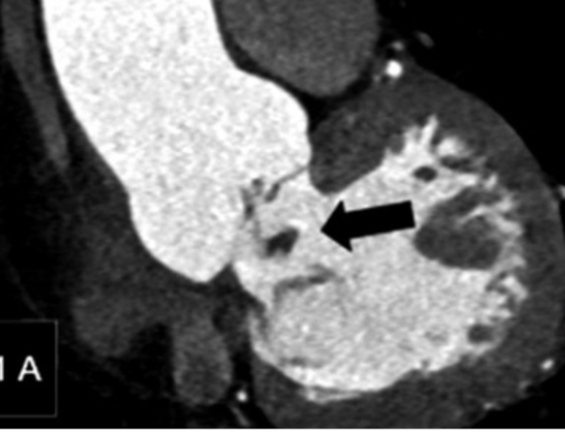 RADdschneider's tweet image. 📖👓 Utilidad Angio-TC cardíaco en la evaluación de la endocarditis infecciosa. Una revision de hallazgos en casos locales, lee el artículo completo acá ➡️ revistamedicadechile.cl/index.php/rmed… @marzagod @medufro @AlemanaTemuco @HHHATEMUCO