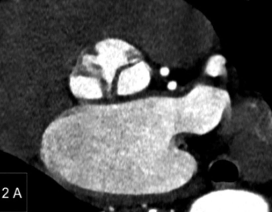 RADdschneider's tweet image. 📖👓 Utilidad Angio-TC cardíaco en la evaluación de la endocarditis infecciosa. Una revision de hallazgos en casos locales, lee el artículo completo acá ➡️ revistamedicadechile.cl/index.php/rmed… @marzagod @medufro @AlemanaTemuco @HHHATEMUCO