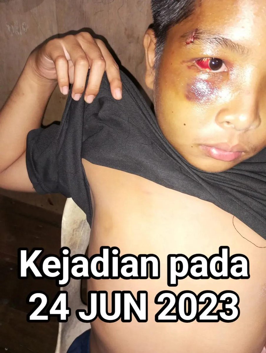 mynewshub's tweet photo. SMKA Tun Datu Mustapha dah banyak kes buli berlaku sebelum ini.

Adik ni pelajar sekolah yang sama dibuli sehingga tahap ni pada 2 tahun lepas. Keluarga memang sangat marah & nak saman sekolah tetapi kewangan tidak mengizinkan. 

Bila kes kematian Adik Zara viral, mak ayah pelajar ni kesal sangat kerana tak saman sekolah masa tu.

Mungkin jika masa tu kejadian ini viral atau pihak sekolah di saman, kejadian yang menimpa adik Zara dapat dielakkan.

Sumber : FB Zakaria Bulkiah