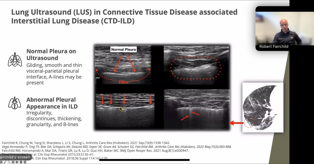 USSONAR_Rh's tweet image. Thank you @RobFairchildMD for excellent talk on lung ultrasound (LUS) in detecting ILD in patients with systemic rheumatologic disease. LUS a safe, effective way that rheum sonographers can eval for ILD with high specificity and sensitivity.
#Rheum #ILD #Ultrasound #POCUS