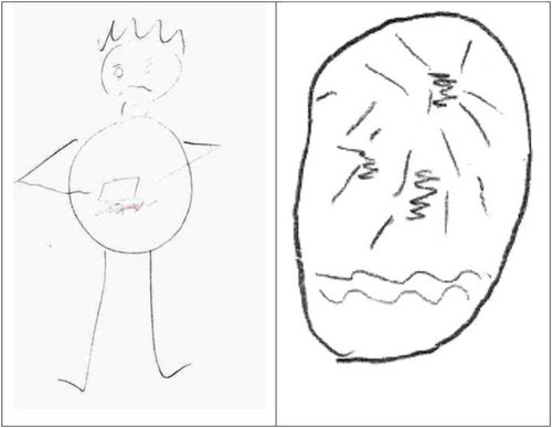 رسم آلام البطن: أداة قوية للتمييز بين آلام البطن العضوية والوظيفية

🟠تم تسجيل وتحليل اثنين وعشرين تفاعلًا. شُخِّص خمسة عشر طفلًا بألم عضلي عضوي، وسبعة أطفال بألم عضلي وظيفي. وجدنا فروقًا ملحوظة بين الأطفال المصابين بألم عضلي عضوي وآخر وظيفي. على سبيل المثال، رأى جميع الأطفال