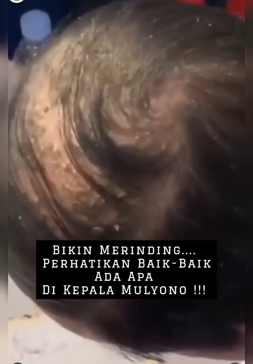 Kulit kepala Jokowi mengelupas sangat cepat. Ini gejala autoimun berat dan agresif. 
#ReuniSampahOrangUtan 

Penderita autoimun tak boleh terpapar sinar matahari. Gak usah reuni2 dulu. Gak usah liburan2 dulu.
#ReuniSampahOrangUtan 

Oleh2 reuni 26/7/2025 fakultas kehutanan Jokowi