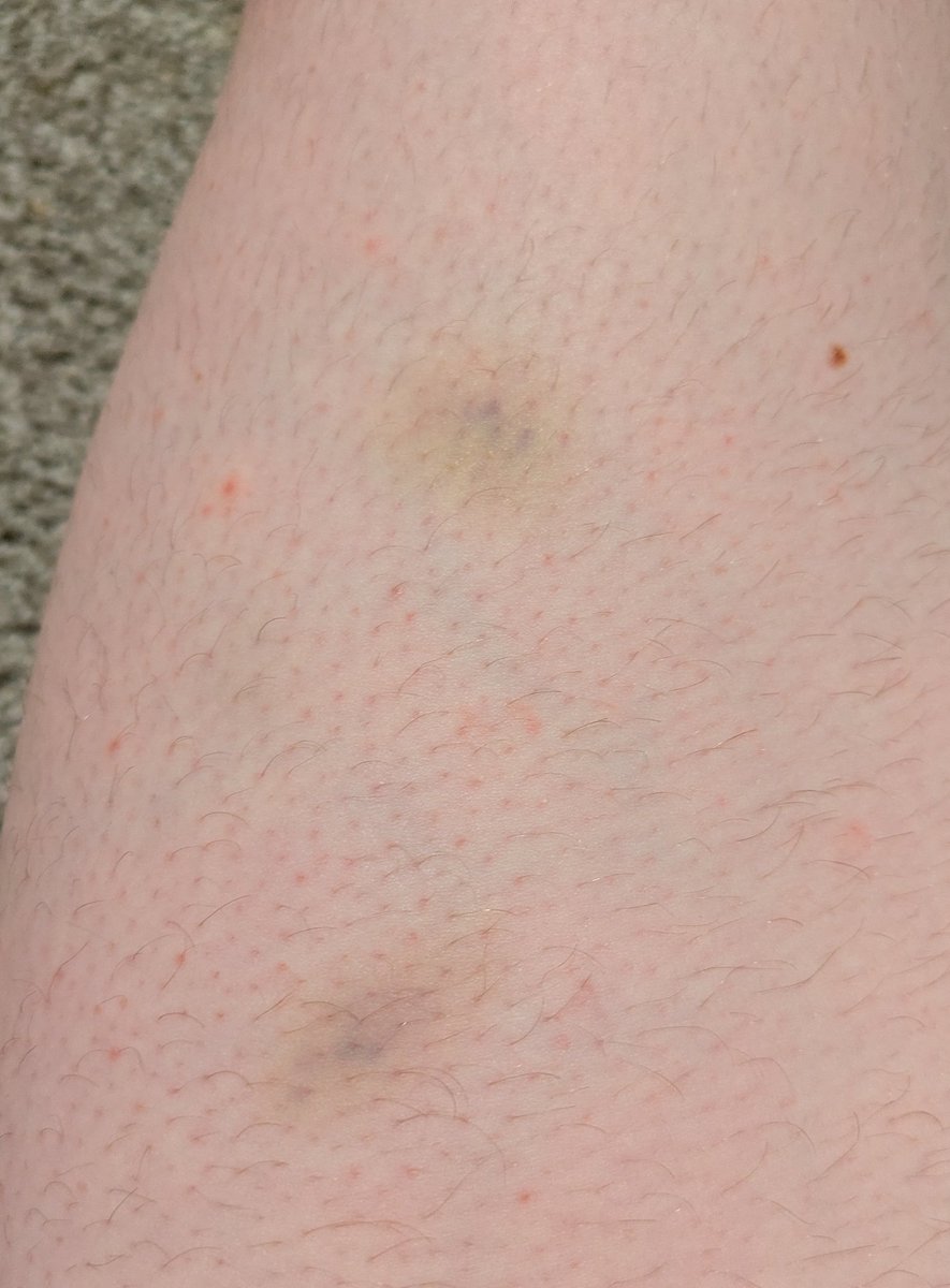 zedsamcat's tweet image. Bruised and battered (left thigh)