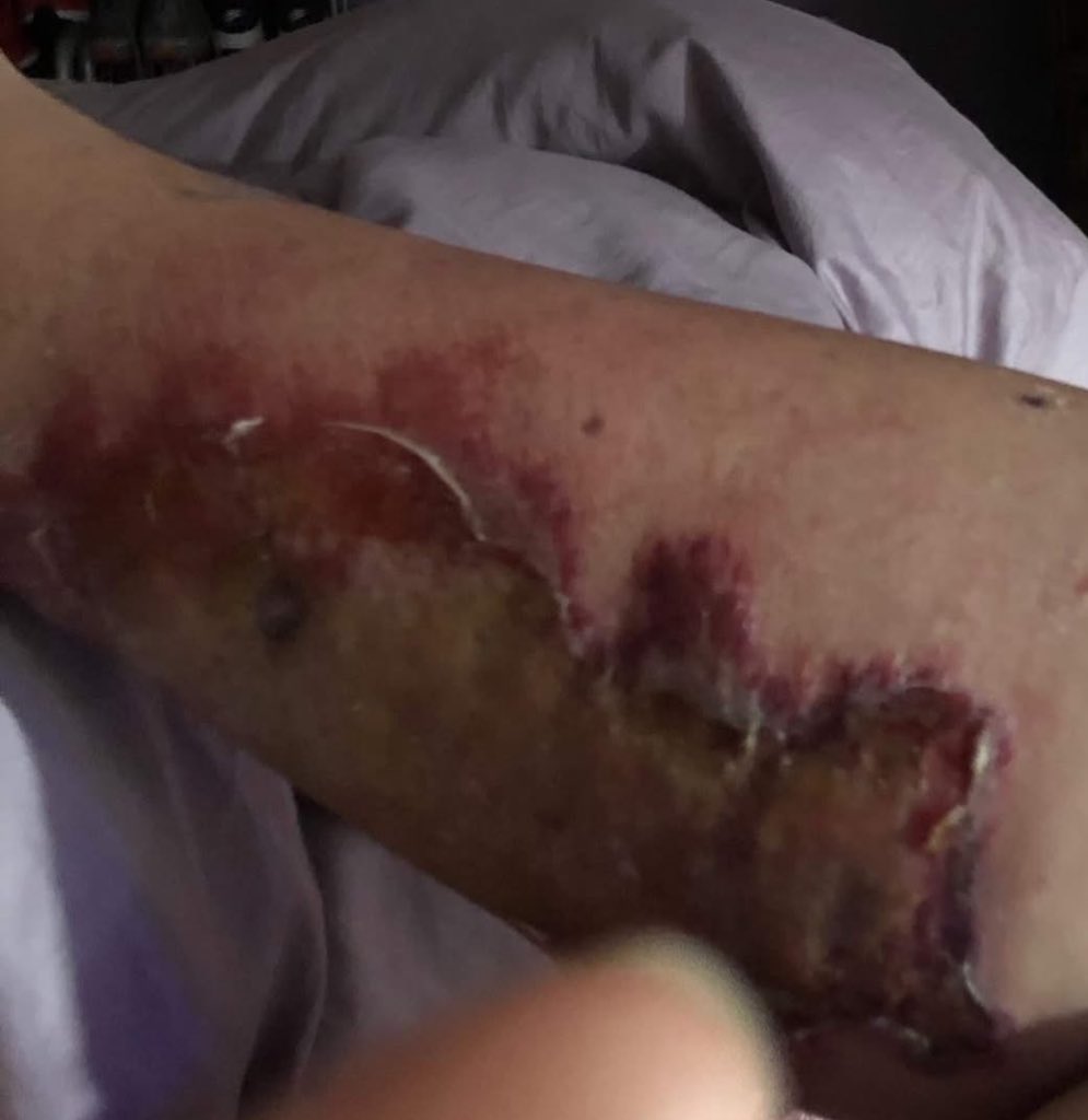 YdoUH8M3's tweet image. 🚨 FLESH-EATING BACTERIA KILLS 4 IN FLORIDA — HEALTH ALERT ISSUED 🦠
Florida health officials are warning beachgoers and seafood lovers: a deadly bacteria is lurking in the water — and it’s already claimed four lives 7 others hospitalized!
The killer? Vibrio vulnificus, a…