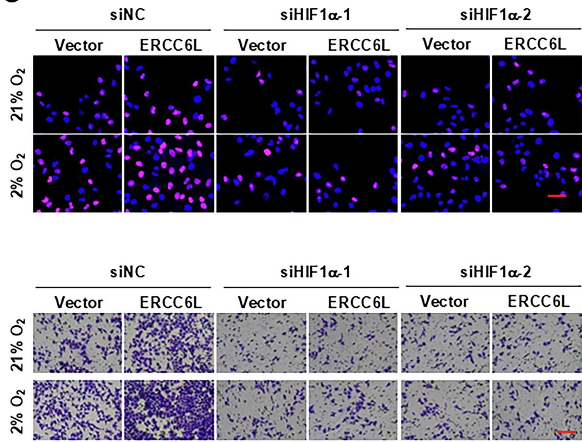 Researchers from Jiaxing University uncovered elevated levels of ERCC6L in #LUAD, significantly associated with unfavorable patient outcomes. 🩺

🕳️ Dig into the details: go.nature.com/414j3hS