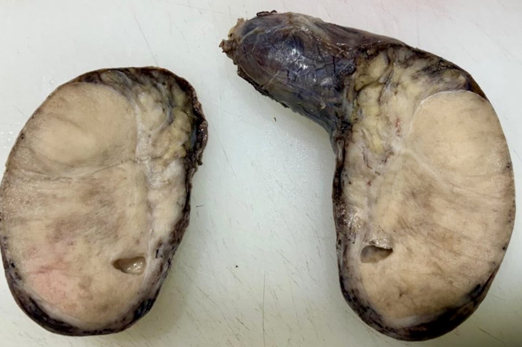The art of grossing. A 75 yo man with a left testicular tumor. Final Diagnosis:Diffuse Large B Cell Lymphoma.#pathologists #pathresidents #pathTweeter #GUpath