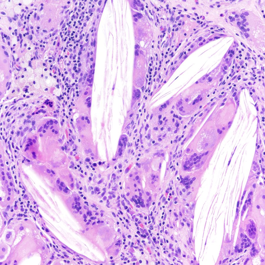 CraigHorbinski's tweet image. Pretty brisk giant cell reaction in a sacrococcygeal #teratoma. #pathology #neuropath #PathTwitter