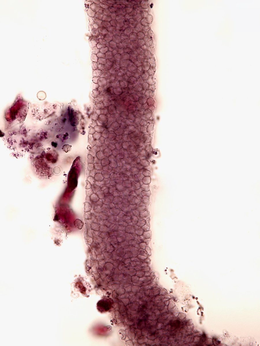 drkeithsiau's tweet image. Spotted under the microscope in a urine sample. What do you see?