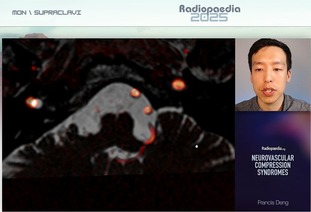 francisdeng's tweet image. Shock-like/stabbing throat, jaw, and/or ear pain on the left
CISS-MRA fusion image showing left PICA compressing CN IX root entry zone
Classic glossopharyngeal neuralgia!
Rounding out #Radiopaedia2025 Day 1 (supraclavicular)