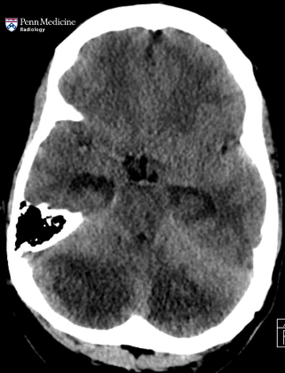 AuntMinnie's tweet image. How would you diagnose this case? 35-year-old man found down at home #radiology @PennMedicine buff.ly/wd1o6dq