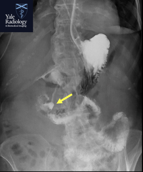 Mahan_Mathur's tweet image. TEACHING COD: great example of pyloric ulcer (arrow), with associated perforation on Upper GI series! #FOAMrad #FOAMed #radres #medstudent #radiology @RadDiscord #MedTwitter @YaleRadRes @Yale_IR